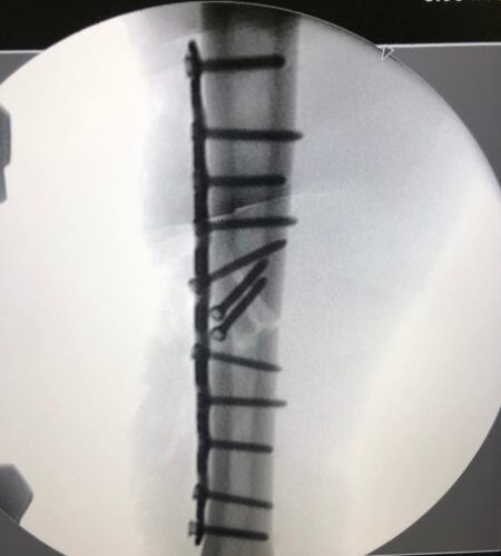 Marquez reveals plates and screws in broken arm