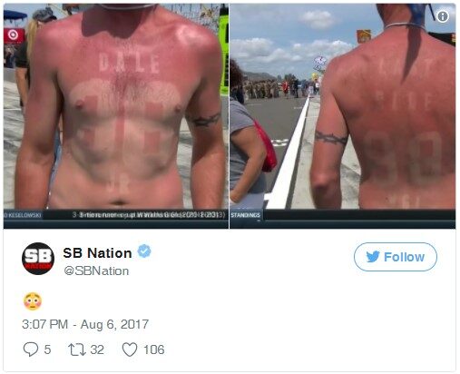 Bubba Fan gets bad sunburn for Dale Jr.